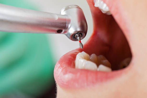 Best Emergency Tooth Extraction in Harvey, ND